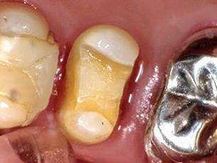 CAD/CAM インレー