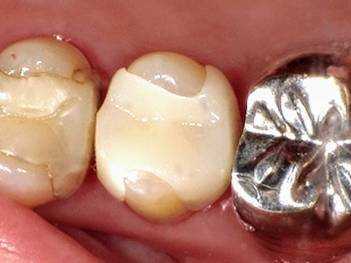 CAD/CAM インレー