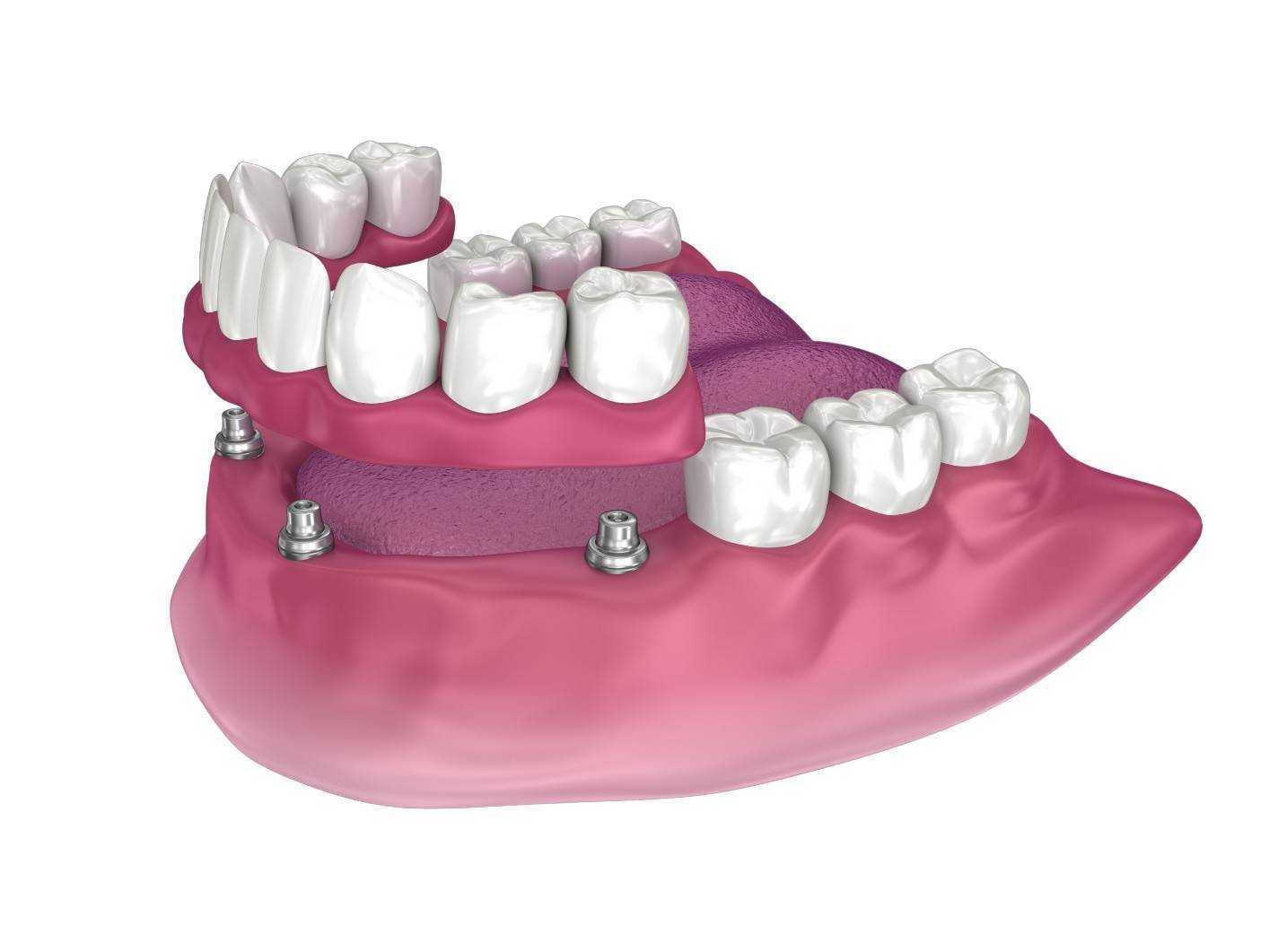 インプラント義歯