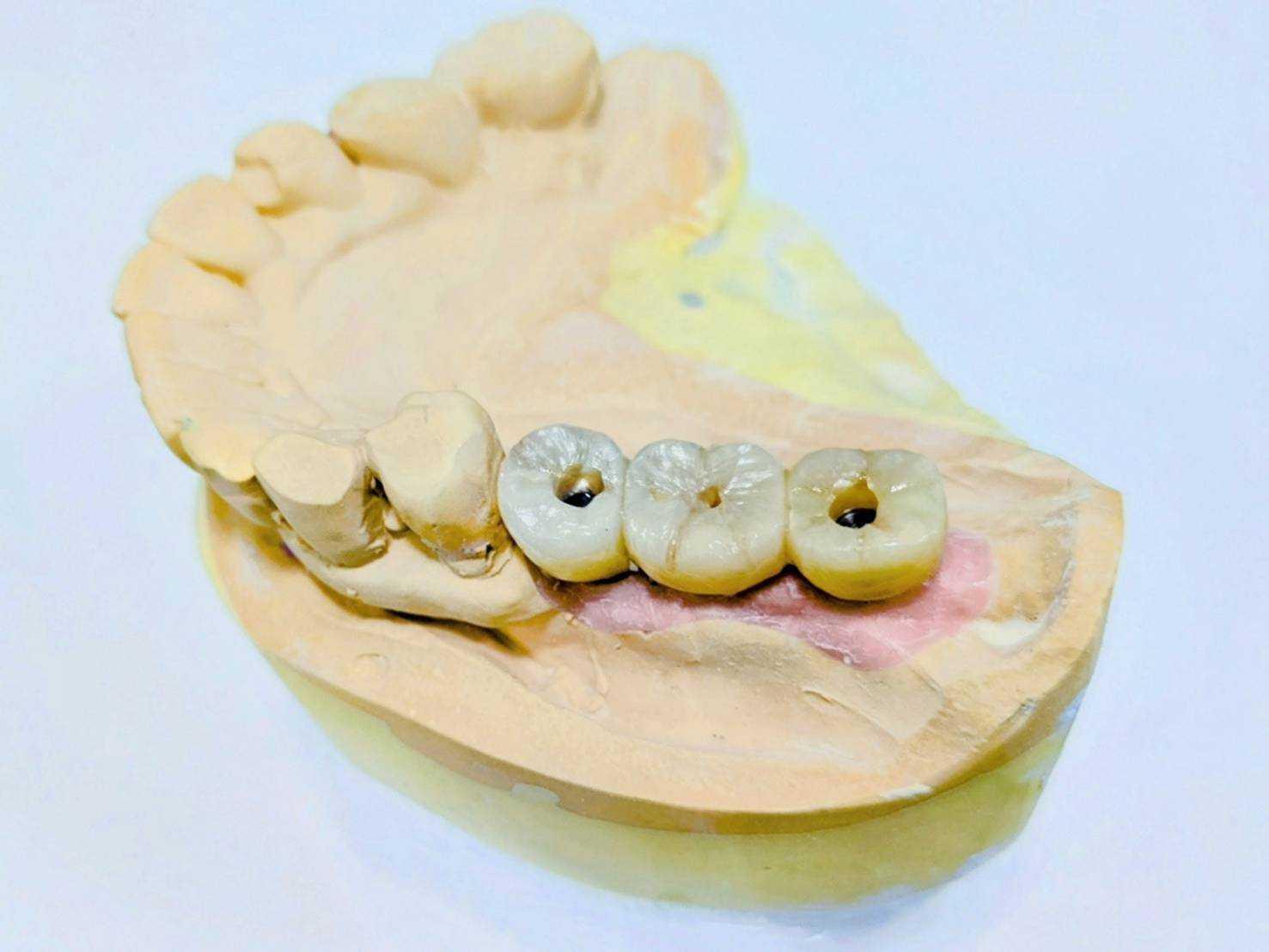 インプラント模型１