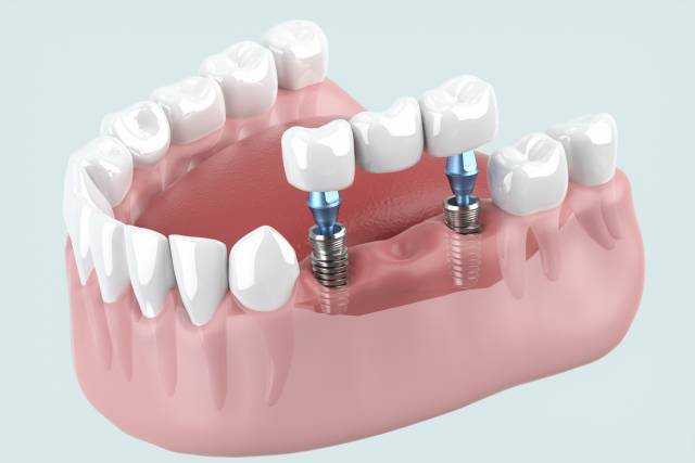インプラント模型２